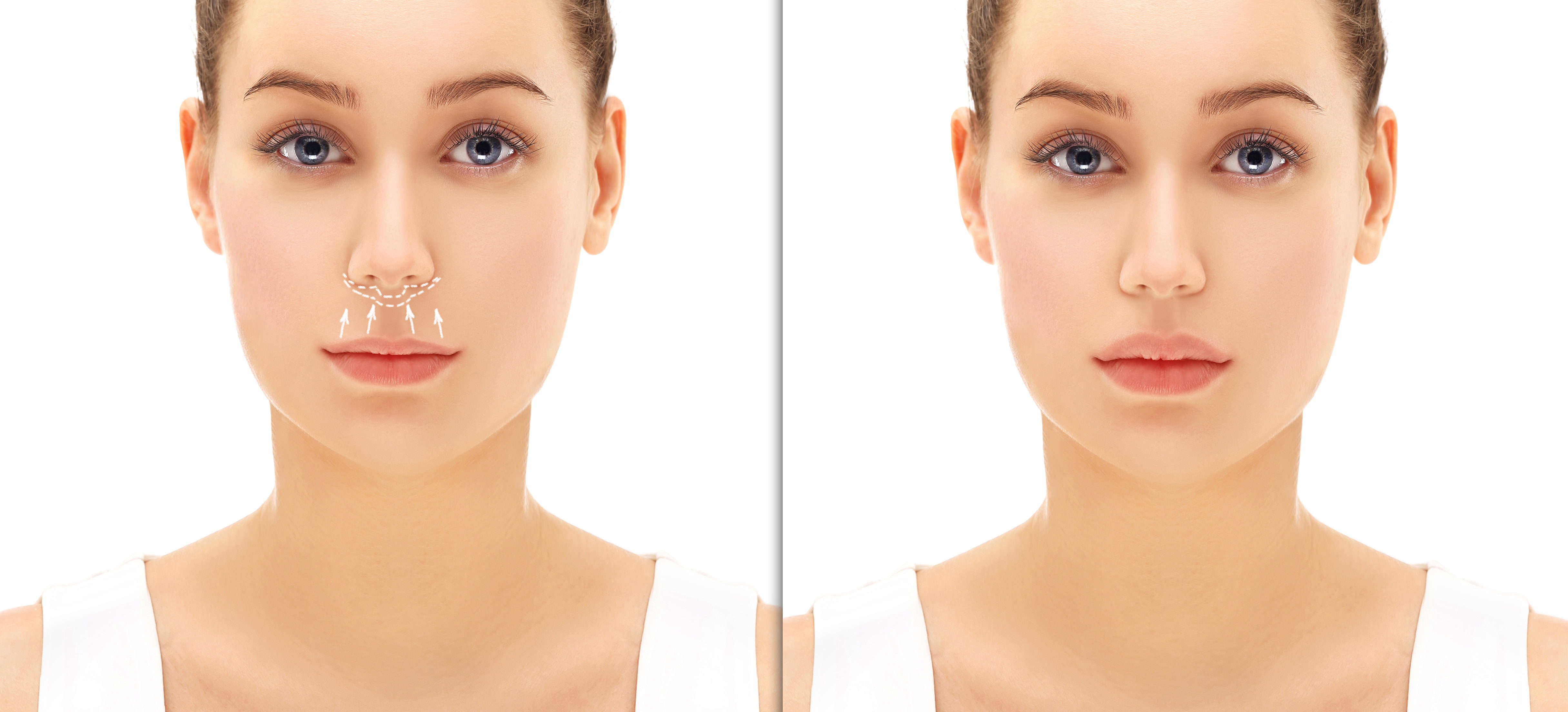 herstel na een liplift herstel na een liplift